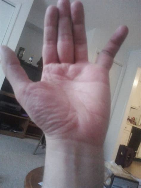 This swelling can also occur in the surrounding fingers. Probably broke my pinky finger today. No insurance. Anyone ...