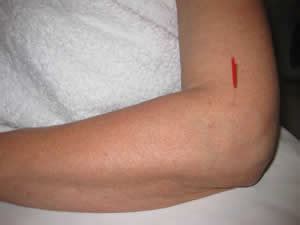 Your doctor will ask you about your symptoms and examine you. Acupuncture for Tennis Elbow - Robina 7 Day Doctors and ...