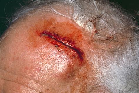 Scalp laceration - Stock Image - M330/1005 - Science Photo Library