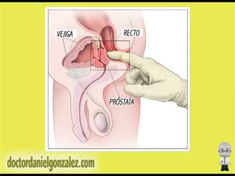 Cancer de prostata sintomas y signos iniciales. Cancer de colon sintomas iniciales. Care să contacteze ...