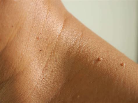 How to identify and remove a skin tag | Business Insider India