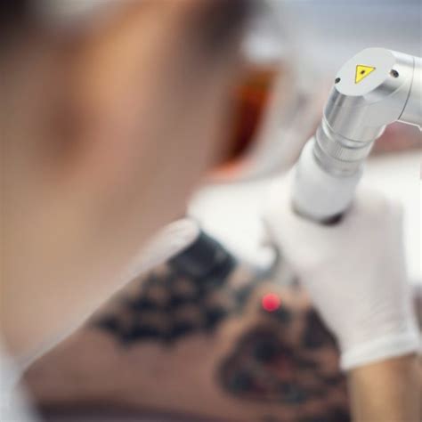 Find out about laser tattoo removal in bournemouth, how it works, if it is painful, how long it takes and other commonly asked questions. News & Updates | Sacred Laser