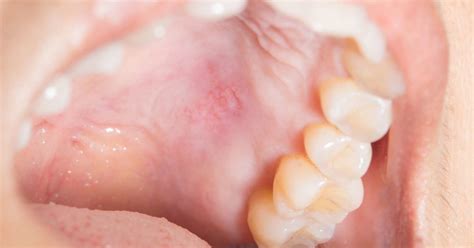 These tiny palatal cysts are harmless. Bump on the roof of the mouth: 12 causes