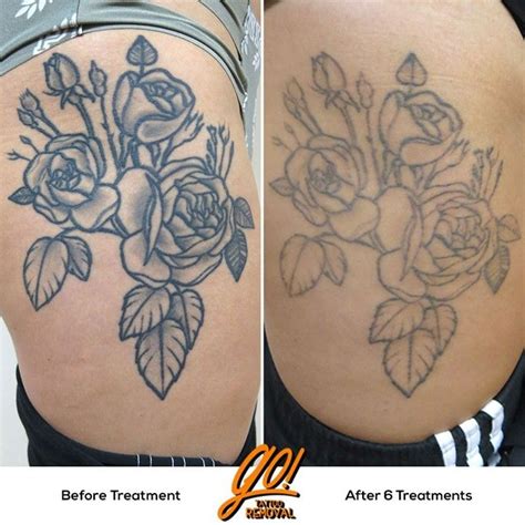 Dec 31, 2020 · it's best to reapply the product at regular intervals so you're not left in pain. This heavily scarred tattoo is finally giving way after 6 treatments. The grey-wash is all but ...