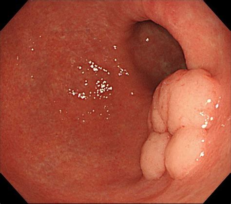 Many people say there is no pain when asked what does cancer feel like. the reason behind this is that cancers don't have any nerves. Stomach Cancer Diagnosis - Dr Anastasios Christodoulou