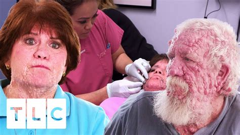 Pimple popper on you tube. Siblings With Rare Skin Condition Seek Dr. Lee's Help | Dr ...