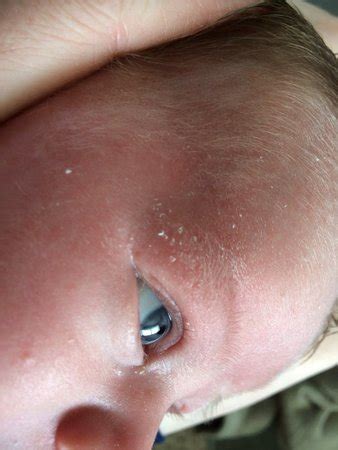 This is completely normal and quickly gets better. Remedies for Lo's very dry skin? | BabyCenter