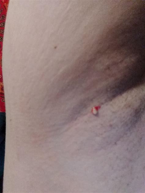 Attacking it with your tweezers is likely to create or worsen an infection. Its a crappy image but i found a lump in my armpit while ...