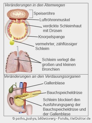 Die krankheit beeinträchtigt die funktion verschiedener organe, vor allem aber der lunge und des verdauungsapparats. Mukoviszidose: Beschreibung, Symptome, Behandlung, Verlauf ...