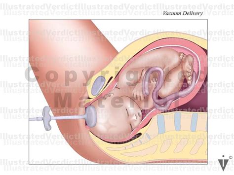 50 kielland forceps named after kielland of norway(rotational forceps 1916), specialised forceps with no pelvic curve. Stock Pregnancy / Delivery: Vacuum / Forceps — Illustrated ...