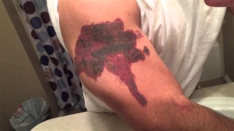 At best, this technique only causes fading of the tattoo. TCA 50% Tattoo Removal - Day 3 - YouTube