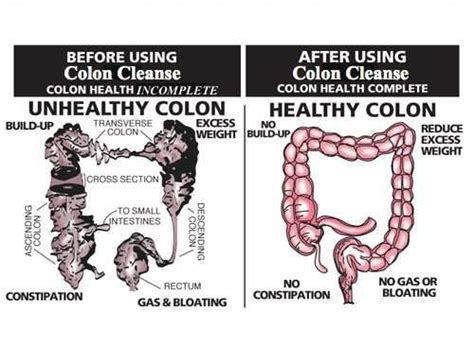 What is the best for parasite cleansing? What You Need to Know About Colon Cleansing - PositiveMed ...