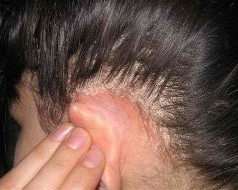 Лущиться шкіра на голові - поради дерматологів по лікуванню і профілактиці Картинка - Лущиться шкіра на голові - поради дерматологів по лікуванню і профілактиці