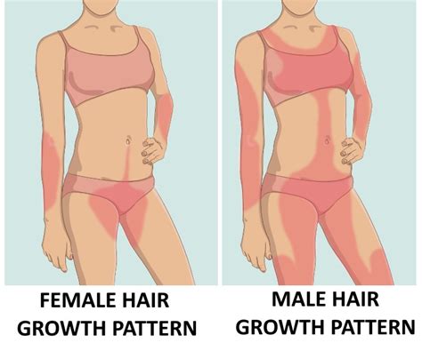 Hirsutism can be seen as coarse, dark hair that may appear on the face, chest, abdomen, back, upper arms, or upper legs. A guide to Excess Hair Growth In Women