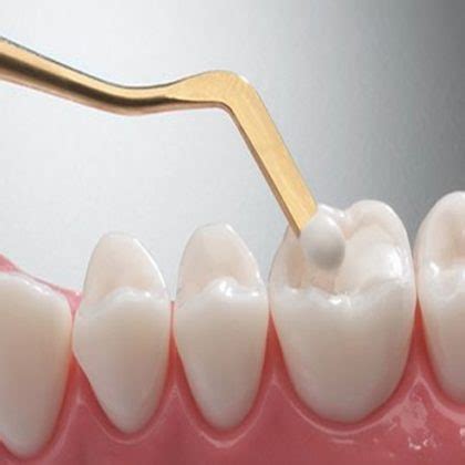 How much does a tooth extraction.cost in trinidad. How Much Does a Dental Filling Cost? | Dentists in North ...