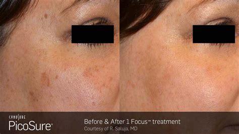 PicoSure FOCUS Before & After Photos | Cosmetic Dermatology