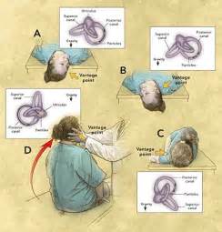 / classiﬁcation of vestibular symptoms: 2015