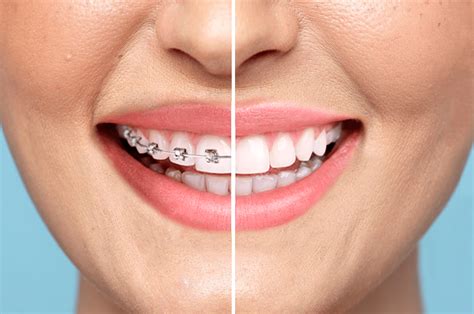 Brace yourself is a way to see yourself with braces on using your ipod touch, iphone & ipad. 3 Surprising Facts About Adult Braces You Should Know | Clear Smiles Orthodontics