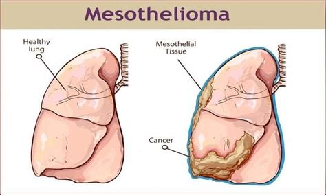 The condition, which is commonly referred to as solitary fibrous tumor of the pleura, appears more frequently in males than females. mesothelioma benign #Mesothelioma | Mesothelioma, Cancer ...
