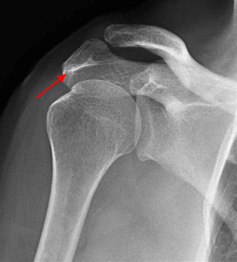 Bone spurs, or osteophytes, are excess bone that grows on normal bone. Bone Spur - Osteophytes, Causes, Signs, Symptoms & Treatment