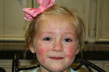 They often as a result of the. Hives on Face