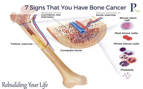 What happens during the procedure? Read about 7 Signs That You Have Bone Cancer