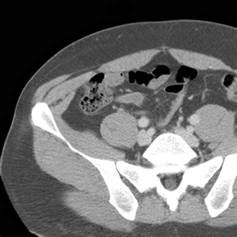 It's innervated by the accessory nerve. Abdominal Wall Muscles Normal Anatomy, Axial CT 6 of 9