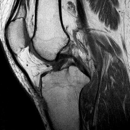 Tibial plateau fatigue fractures | Image | Radiopaedia.org