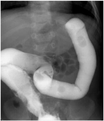 Colectomy with colocolonic, ileocolonic, or jejunocolonic anastomosis may be performed depending on the extent of the disease. Intussusception associated with a Meckel's diverticulum ...