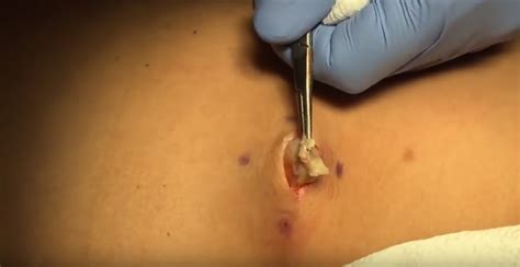 A cyst from ingrown hair can start and grow in areas covered with skin including the scalp, on the face, under armpits, pubic area and groin. pimple popping videos new | New Pimple Popping Videos