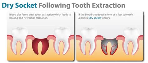 As with any type of surgery, wisdom tooth removal carries some risks. How long until i can smoke after wisdom teeth IAMMRFOSTER.COM