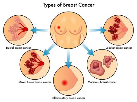 Inflammatory breast cancer symptoms usually start quickly. What is Inflammatory Breast Cancer? - Breast Cancer Conqueror