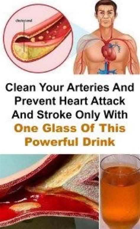 Prolonged or severe chest pain or discomfort not relieved by rest or nitroglycerin. Clean Your Arteries And Prevent Heart Attack And Stroke ...