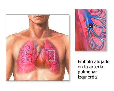 Add a bio, trivia, and more. Émbolo - Información médica en Ferato, enciclopedia de la ...