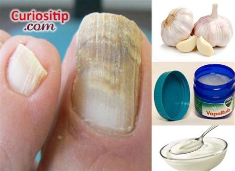 4 TIPS PARA ELIMINAR HONGOS DE LAS UÑAS | Eliminar hongos ...