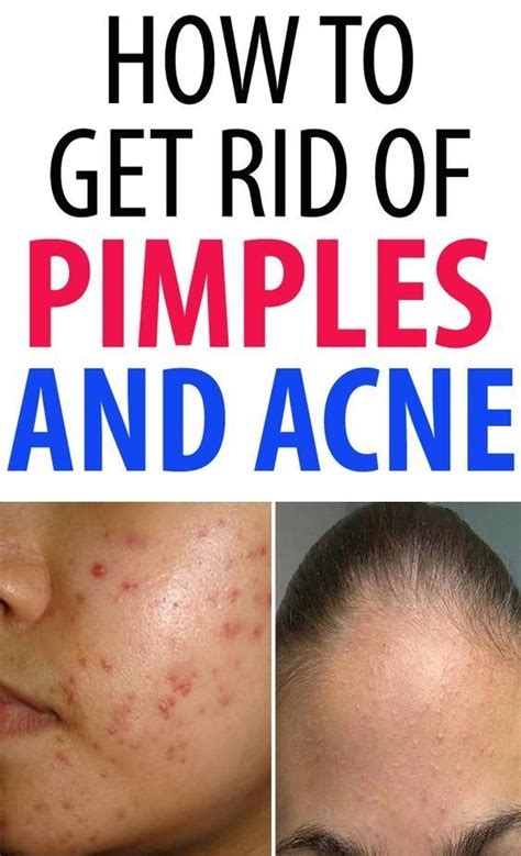 Natural Ways to Get Rid of Acne or Pimples | Back acne treatment, Acne treatment, Diy acne treatment
