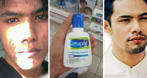 Penyebab jerawat bisa karena banyak hal, mulai dari faktor genetik, perubahan hormon dan lainnya. Cara Hilangkan Jerawat Di Dahi