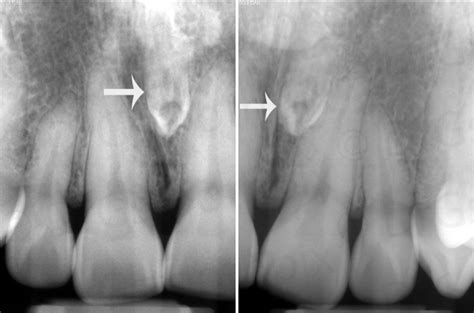 Mesiodens are the erupted or unerupted extra tooth in the midline of maxilla, along with normal teeth (between the central incisors). Locate the Object: September 2014 - Dr. G's Toothpix