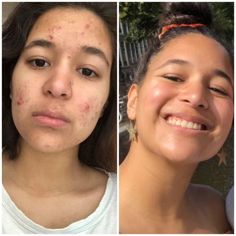 Before and after accutane :)) : acne