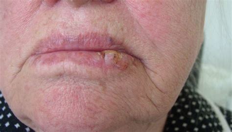 This cancer is greatly connected with tobacco use and alcohol use. Lip cancer: What it looks like and what to do