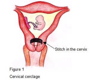 This could be due to numerous reason like any. Cervical cerclage - Gynaecology | BMI Healthcare UK