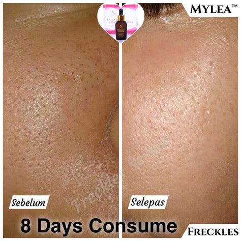 Mylea sesuai untuk semua masalah kulit termasuklah. Miss DeL: MYLEA FRECKLES SERUM