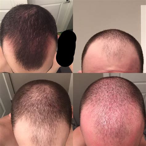 Dutastaride phase 2 hair counts after six month of treatment, the hair counts measured in a 1 inch diameter circle increased by about ~96 hairs with 0.5mg dutasteride, compared to about ~72 hairs with 5mg finasteride. Started Avodart For Hair Loss(0.5 Mg/day) | HairLossTalk ...