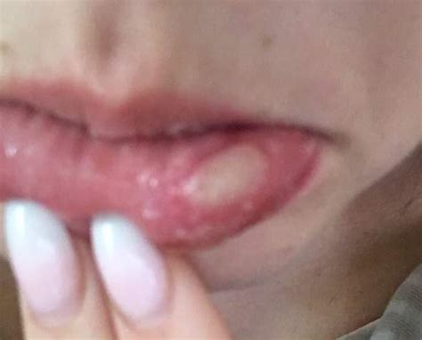 Als auslöser für den akuten schub von herpes auf der lippe kommen viele faktoren (trigger) in betracht, die nicht immer vermeidbar sind. Hilfe was ist das an meiner Lippe? (Gesundheit und Medizin ...