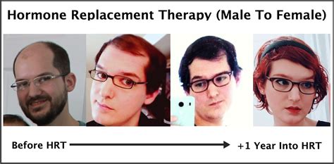 Many don't have scientific backing. Exactly How Trans Hormone Replacement Therapy Regrows Hair ...