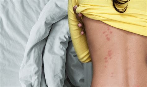 I purchased mine from whole foods and i got the. Can Bed Bugs Only Bite Once? - Bed Bugs Sprays