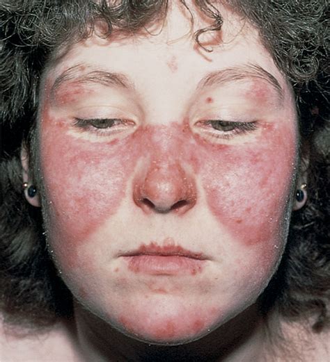 Perfect Treatment of Butterfly Rashes Using Homeopathic ...