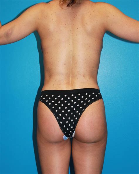 Liposuction of full abdomen and waist. Case 3 - Brazilian Buttock Lift - Before and After Gallery