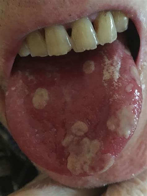 Immunocompromised patients are prone to various infectious and non infectious disorders. Oral lesions in an immunocompromised patient | The BMJ