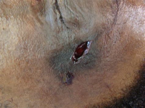 Bullet wound over right parietal bone, 4 inches long, crosses lower end of rolando. Tattooing in Gunshot Wound | Forensic Pathology Online